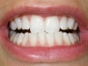 Tooth Whitening