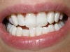 Tooth Whitening