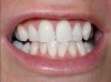 Tooth Whitening