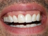 Tooth Whitening & Procera Crown