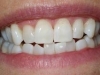 Tooth Whitening