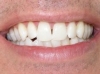 Tooth Whitening