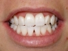 Tooth Whitening