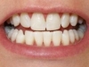 Tooth Whitening