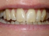 In-Line Clear Brace after 10 months then Composite Bonding