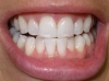 Tooth Whitening