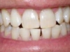 Tooth Whitening