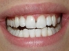 In-Line and Tooth Whitening