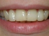 In-Line Clear Brace after 10 months