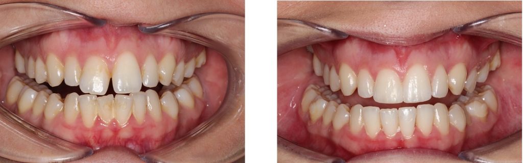 https://www.hartleydentalpractice.co.uk/prod-20160214/wp-content/uploads/2020/01/In-Line-Before-After-1024x320.jpg